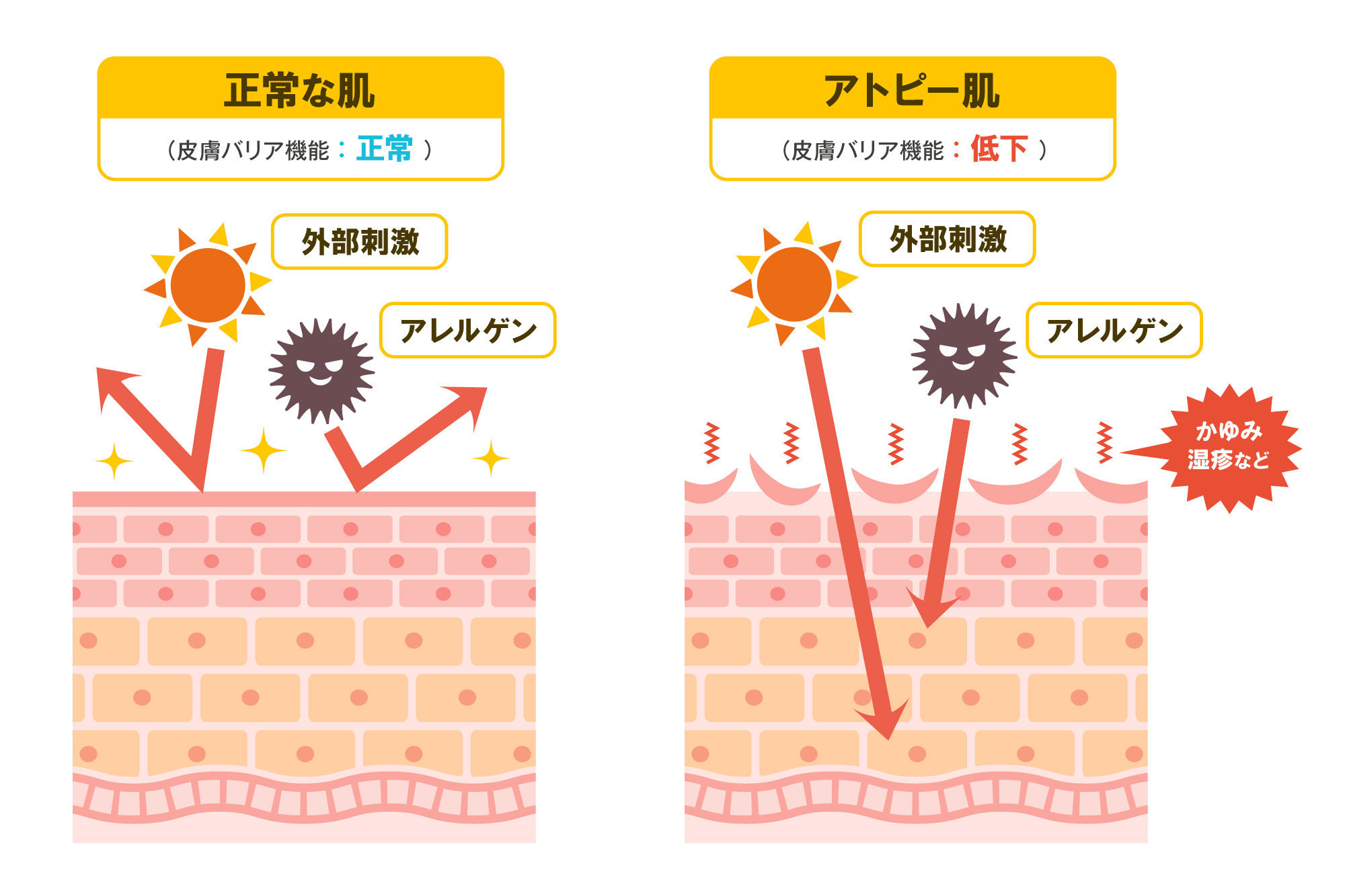 ​什么原因会导致特应性皮炎？脂多糖（LPS）是一种有望改善症